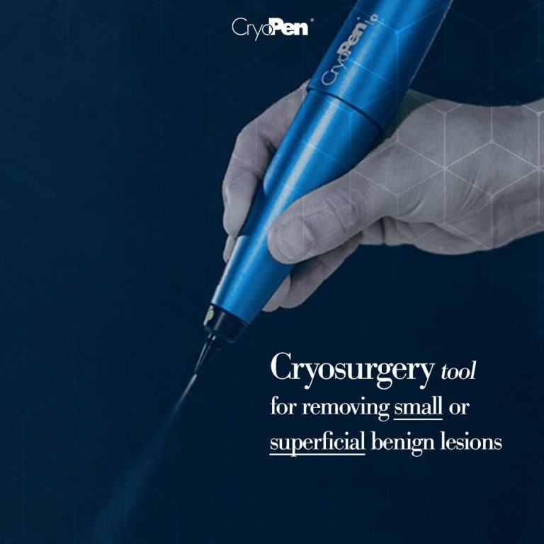 Apa itu perawatan CryoPen?